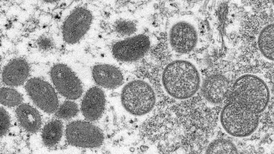 Massachusetts reports first confirmed U.S. case of monkeypox this year