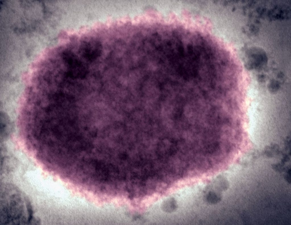 First Monkeypox Case Confirmed in France in Paris Region