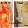 Ultrasound-assisted laser technique vaporizes artery plaque