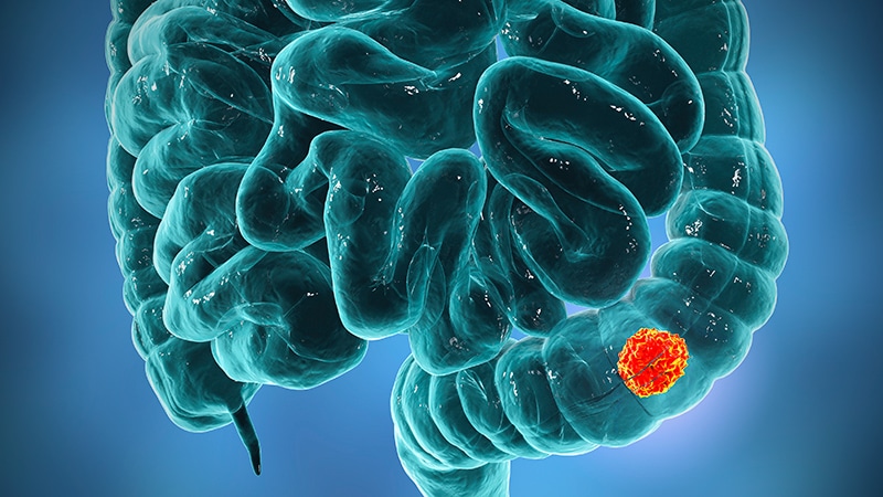 ‘Underwhelming’ Improvements in mCRC Overall Survival