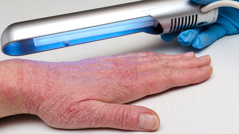 European Survey Finds Phototherapy Use Varies Widely for Eczema