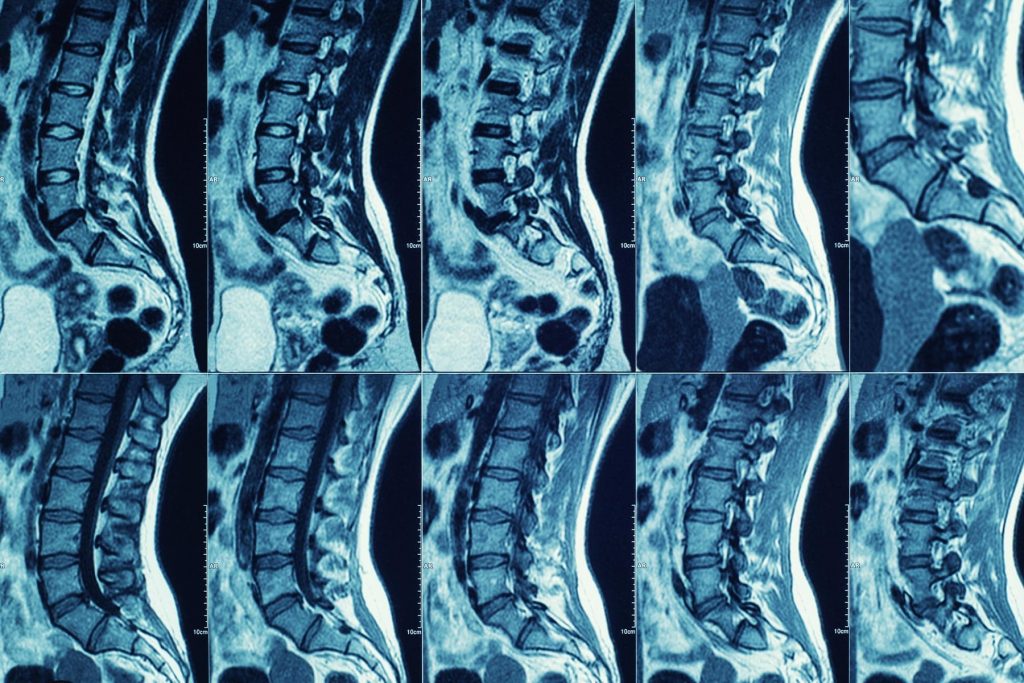 Finding Meaning and Joy After Spinal Cord Injury