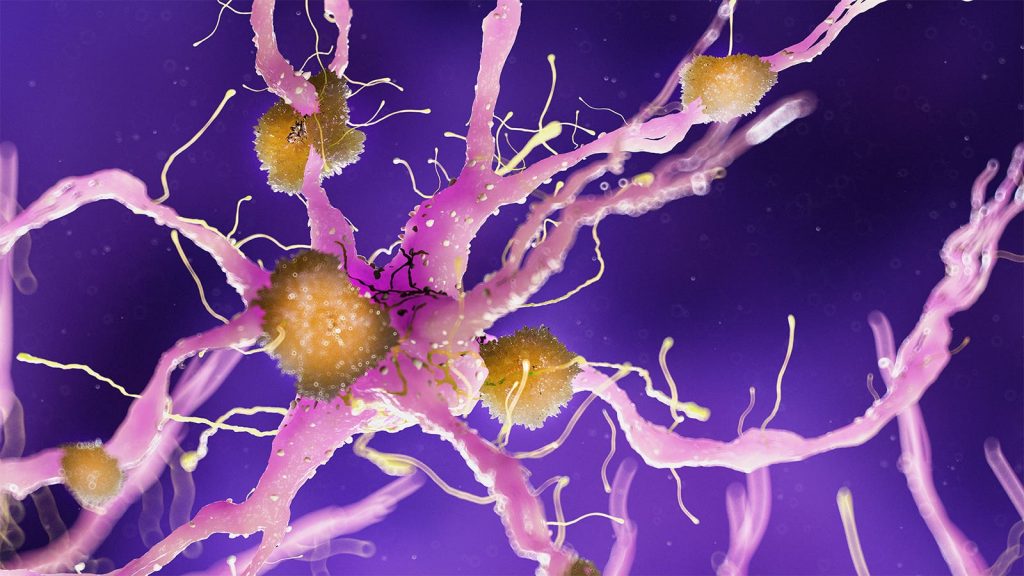 Donanemab Analyses Suggest Benefits for Select Alzheimer’s Patients