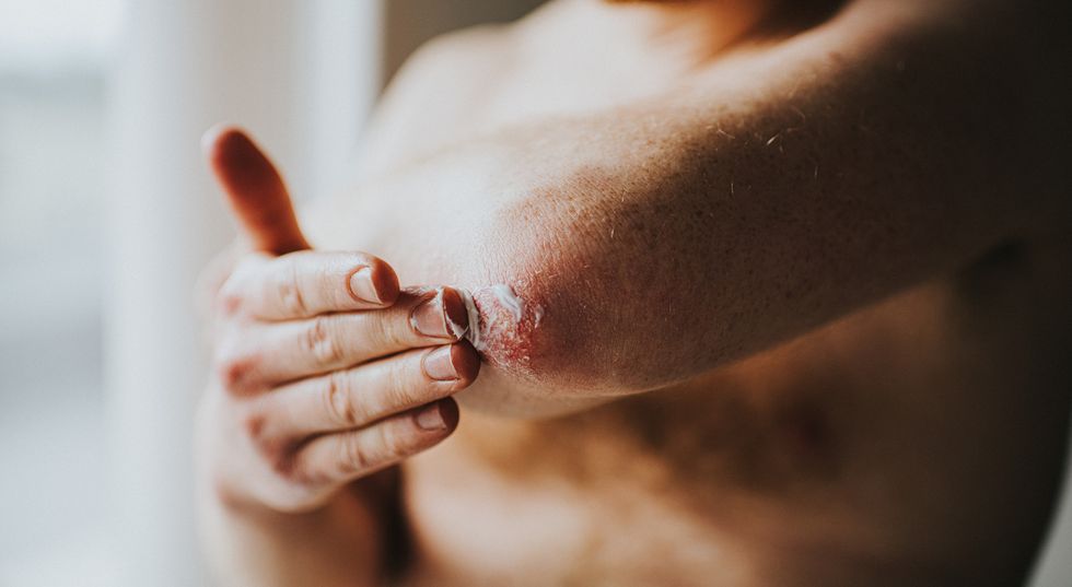 Which Psoriasis Treatment is Right for You?