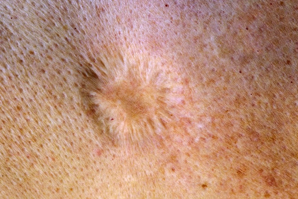 Study Pushes Back Smallpox Origins Another 2,000 Years