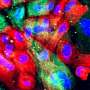 New treatment approach for prostate cancer could stop resistance in its tracks