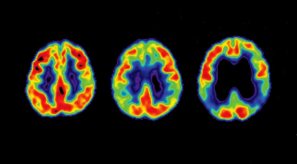 What Drives Alzheimer’s in Women?
